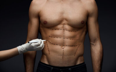The Way to a Six-Pack Abdomen Surgery with CCS Ghana