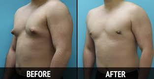 How painful is Male Breast Reduction Surgery by CCS Ghana